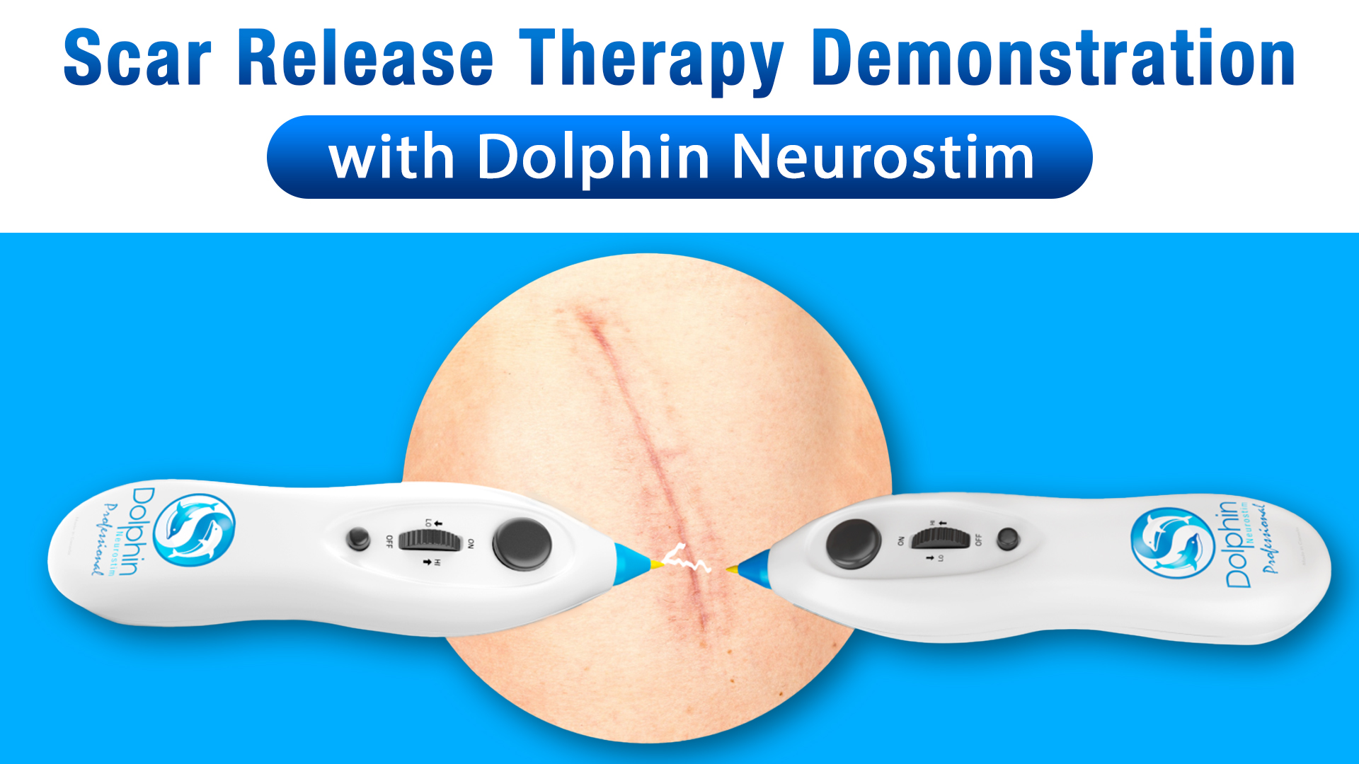 Amazon.com : Electronic Acupuncture Pen for Scar Healing | Dolphin