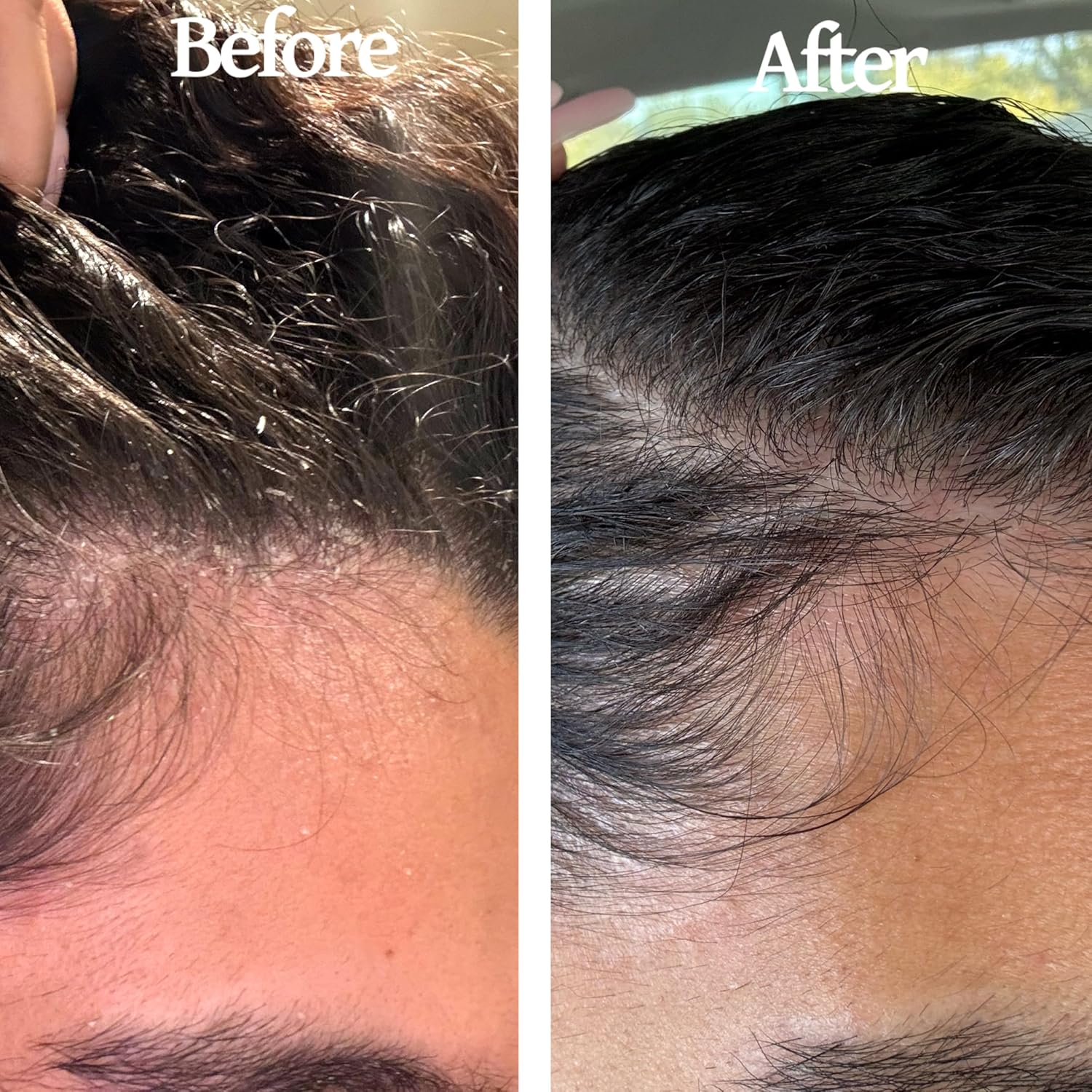 Finally All Natural Scalp Oil & Brush Set for Fuller Hair & Healthier Scalp. Hair Growth & Dandruff Relief – Soothes Itchy Dry Scalp, Hair Loss Treatment w/Amino Acids, Hair Strengthening