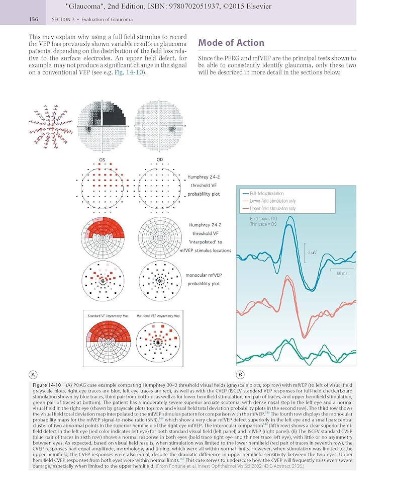GLAUCOMA 第2版 volume 2のみ Glaucoma: 2-Volume Set: 9780702051937: Medicine & Health