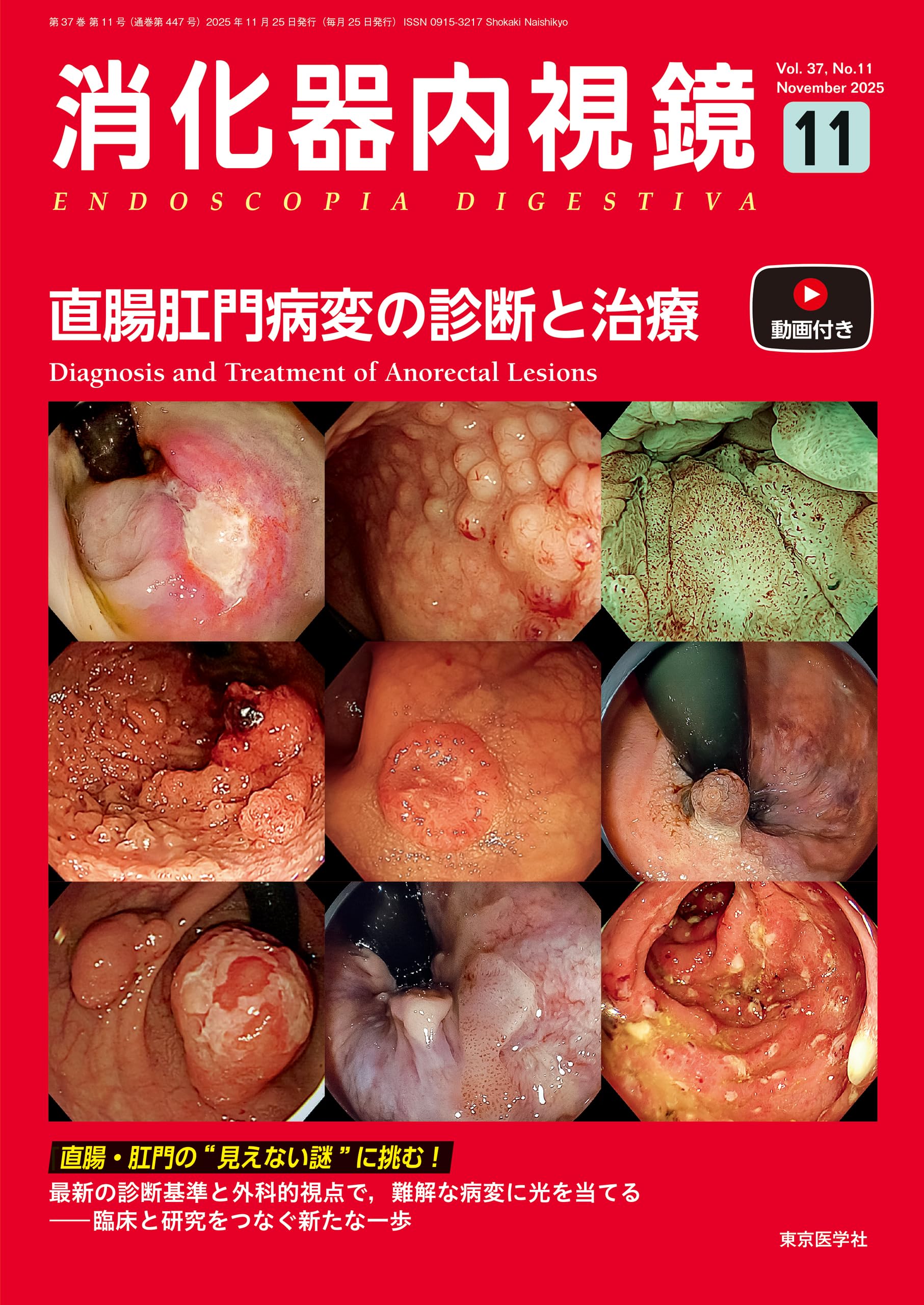 消化器内視鏡37巻11号2025年11月号 直腸肛門病変の診断と治療 | 「消化
