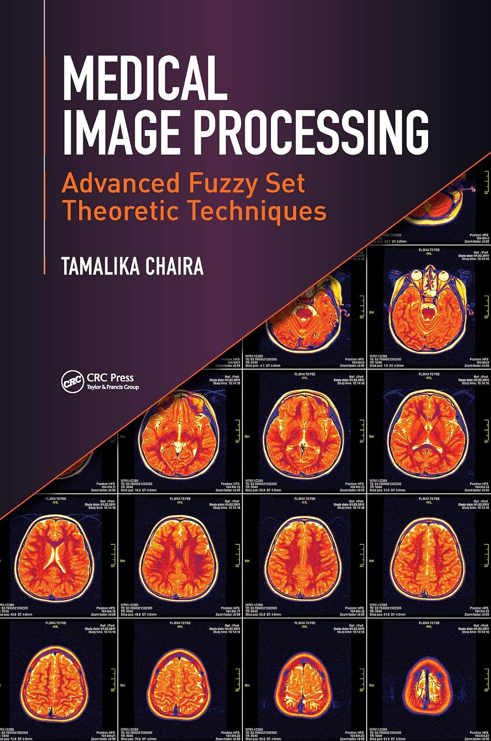 Medical Image Processing: Advanced Fuzzy Set Theoretic Techniques