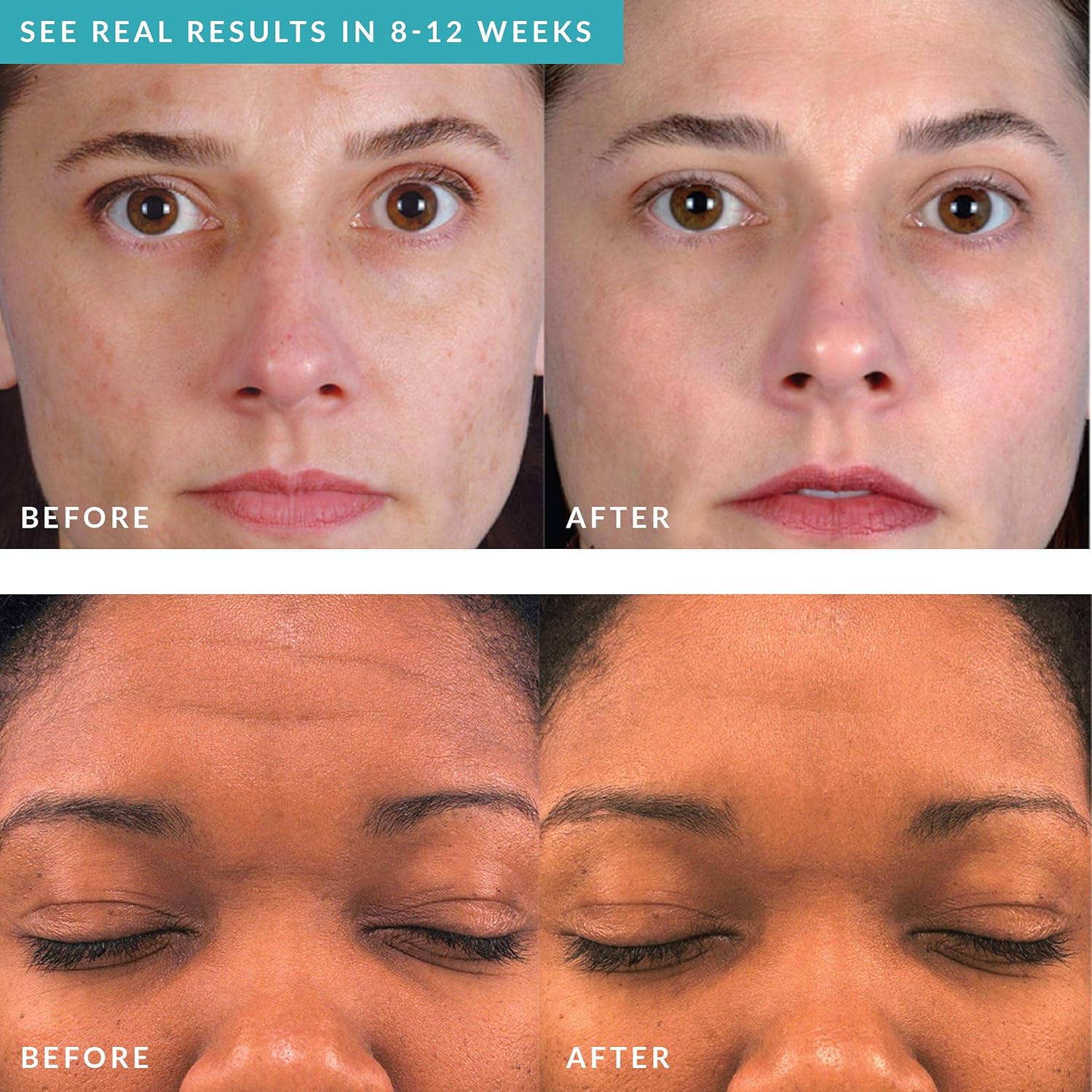 PMD Personal Microderm Pro - At-Home Microdermabrasion Machine with Kit for Face & Body - Exfoliating Crystals and Vacuum Suction for Fresh and Radiant Skin - High & Low Speed Options : Beauty & Personal Care