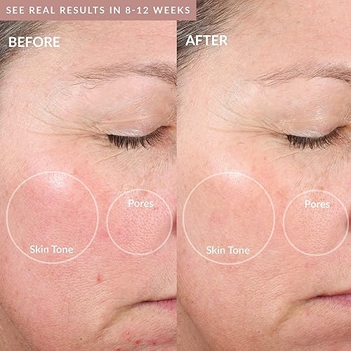 Miniatura 4 de PMD Personal Microderm Elite Pro - At-Home Microdermabrasion Machine with Kit for Face and Body - Exfoliating Crystals and Vacuum Suction for Fresh