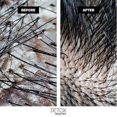 Miniatura 8 de Ybera Professional Detox Healthy DUO  Cuidado refrescante para grasa  Previene la pérdida de cabello  Estimula el crecimiento y mejora el cabello