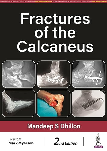 Fractures of the Calcaneus (English Edition)
