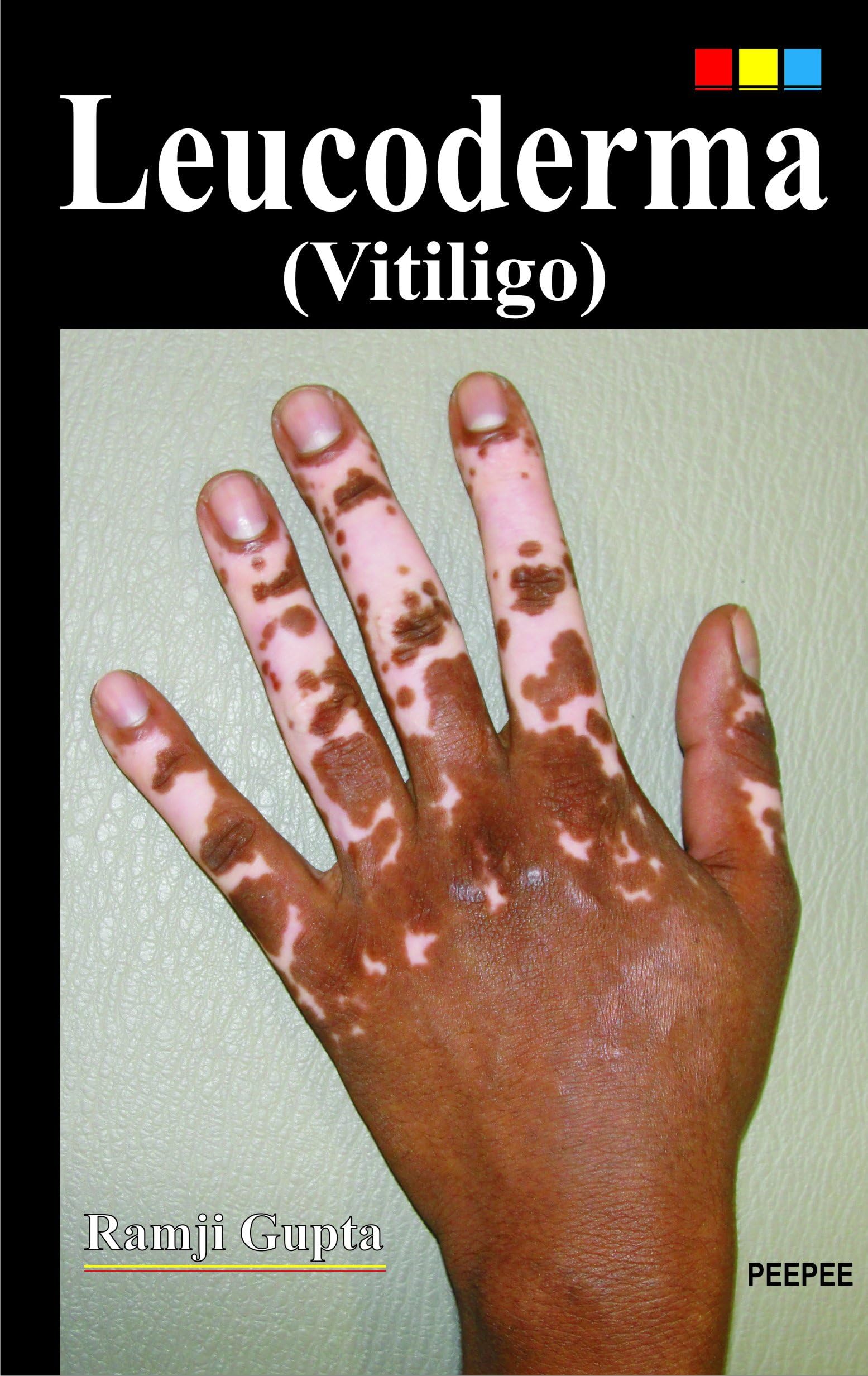 Leucoderma (Vitiligo) Unknown Binding – 1 January 2016