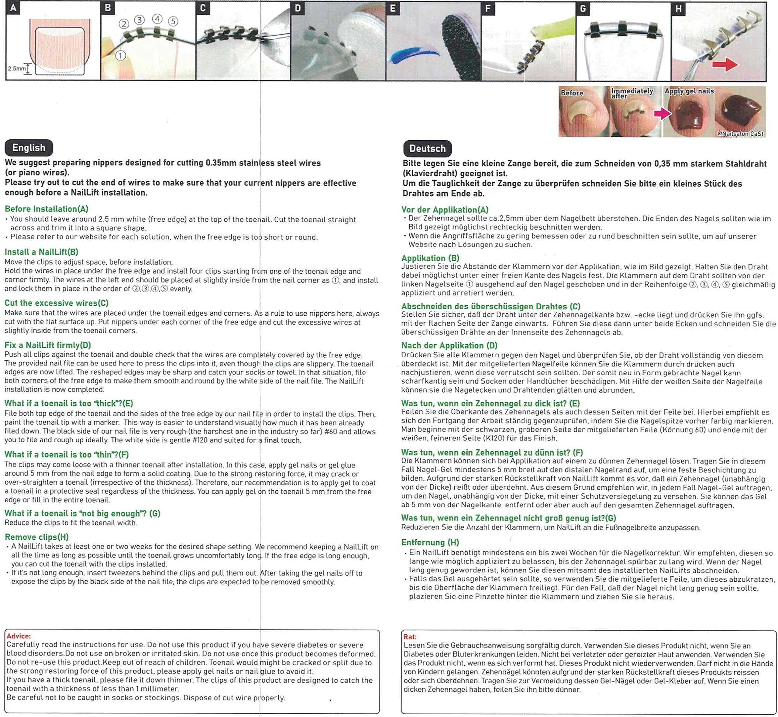 Correzione unghie per unghie incarnite | nuova innovazione | Progettato da medicina | Effetto immediato | Adatto per tutte le dimensioni delle unghie | vestibilità naturale