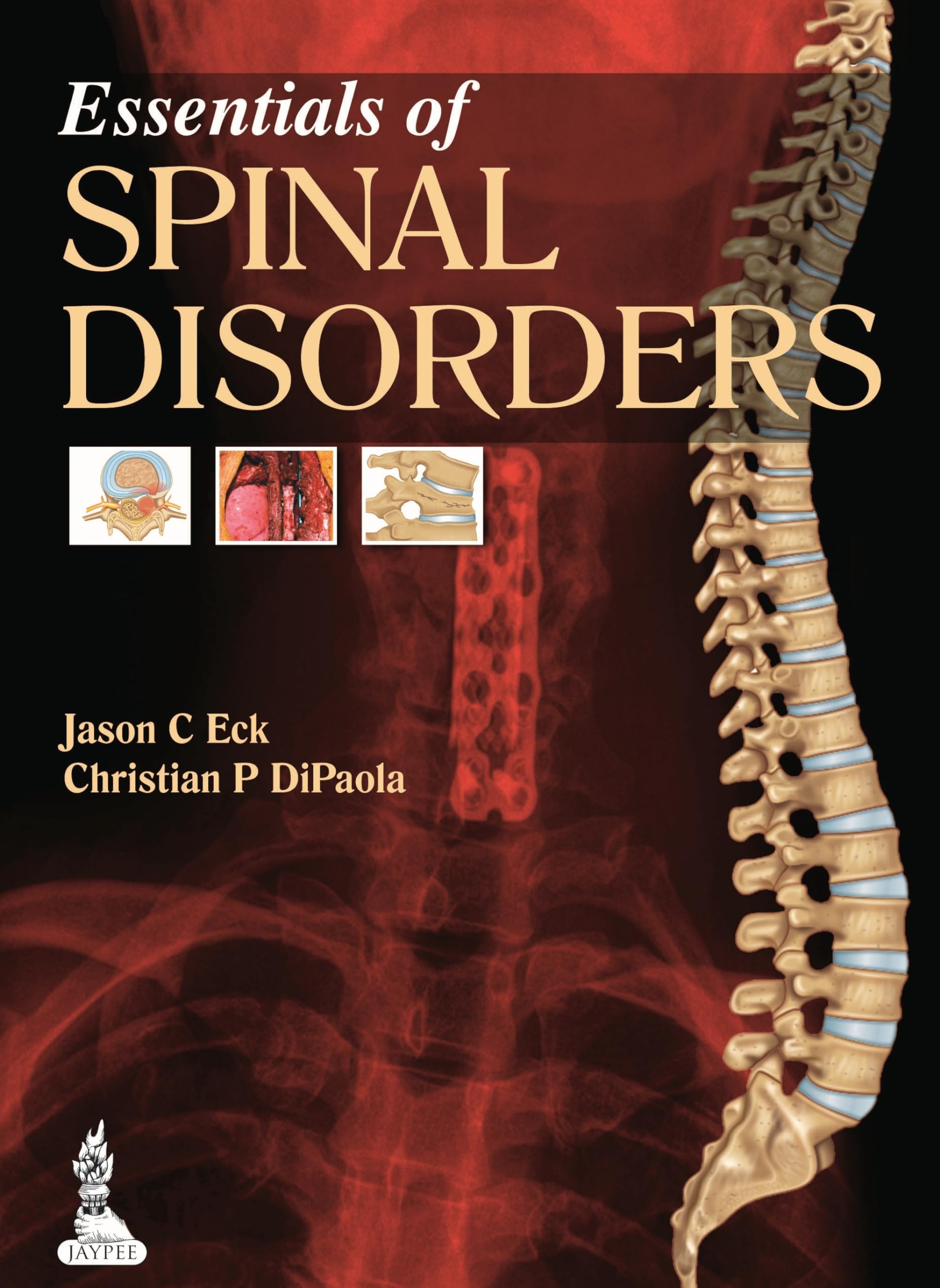 Buy ESSENTIALS OF SPINAL DISORDERS Book Online at Low Prices in