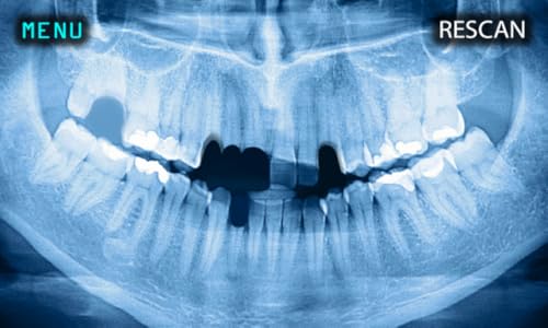 X-Ray Scanner Human Teeth