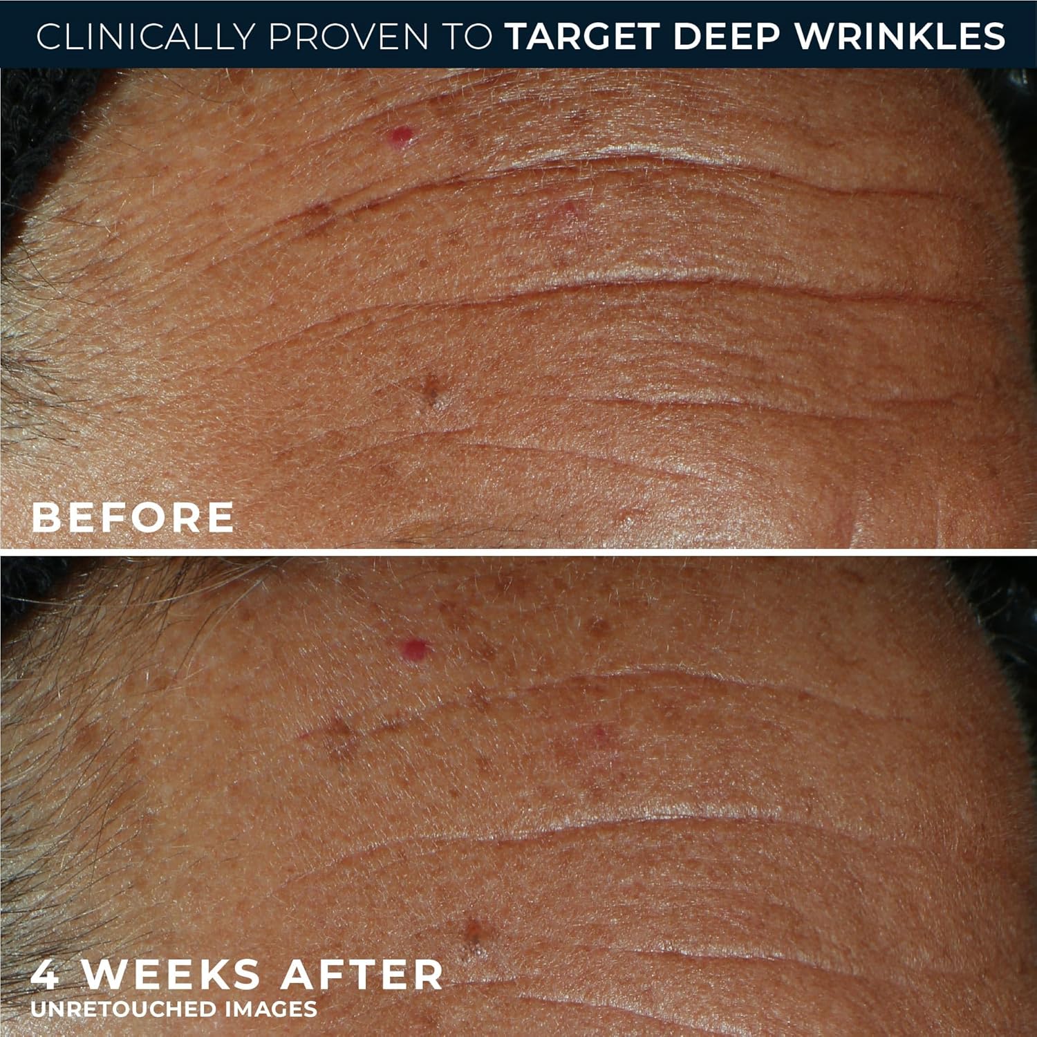 RoC Derm Correxion Fill + Treat Advanced Retinol Serum, Wrinkle Filler Treatment with Hyaluronic Acid for Crow's Feet, 11 Wrinkles, & Laugh Lines, (.5 fl oz) with Retinol Packette (Packaging May Vary) - Image 6