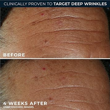 RoC Derm Correxion Fill + Treat Advanced Retinol Serum, Wrinkle Filler Treatment with Hyaluronic Acid for Crow's Feet, 11 Wrinkles, Laugh Lines, (.5 fl oz) with Retinol Packette (Packaging May Vary)