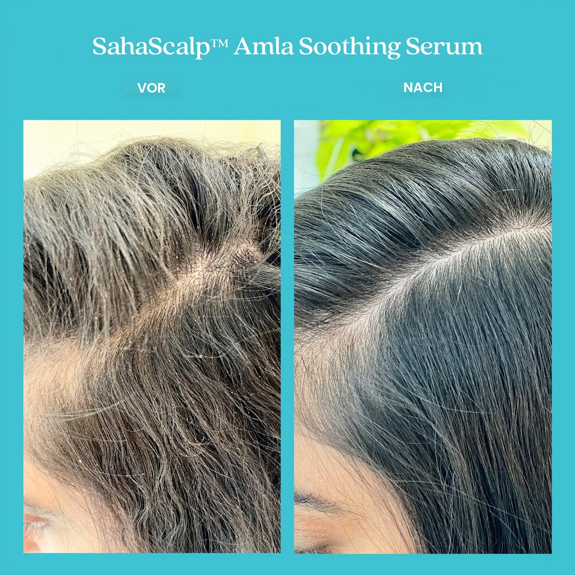 Fable & Mane Amla Beruhigendes Serum mit Rosmarinöl reinigt und gleicht Irritationen aus. Detox-Behandlung für trockene, juckende oder empfindliche Kopfhaut