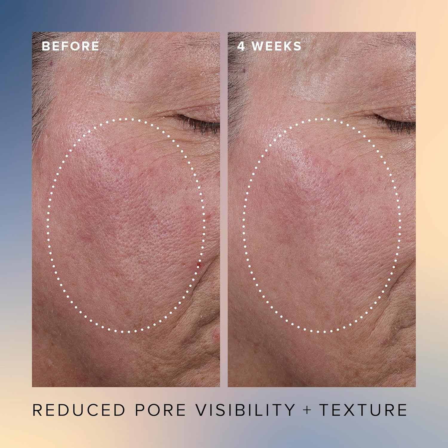 Farmacy Honey Glow 17% AHA & BHA Resurfacing Night Serum - Facial Serum with Hyaluronic Acid - Reduces Fine Lines & Pores (1 Fl. Oz.) Synthetic Fragrance Free 1.01 Fl Oz (Pack of 1) image 3 of 8 B0CN1TCCX8