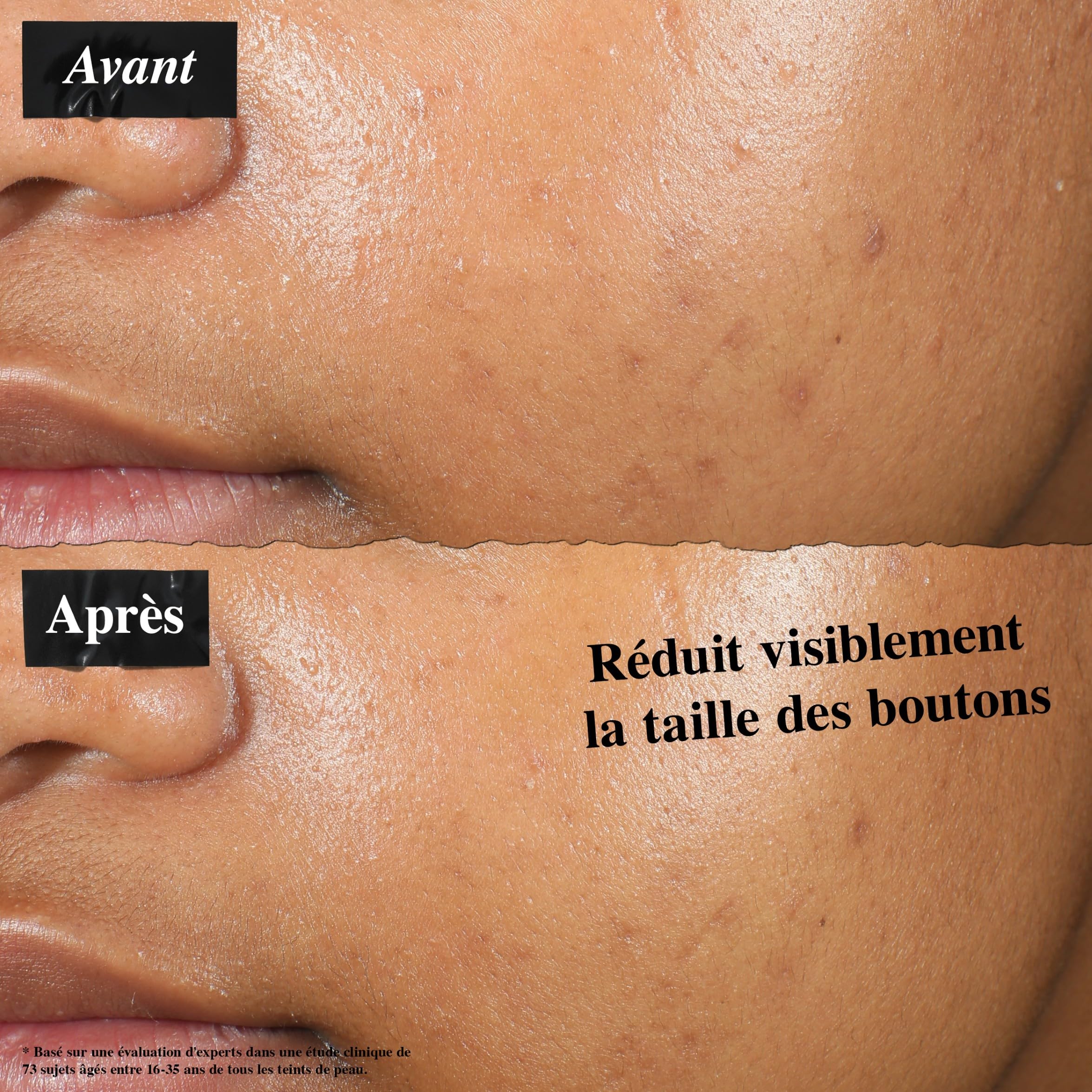 Kiehl's, Solution Ciblée Anti-Imperfections Dermatologist Solutions, Patch Liquide Invisible Concentré avec 2% d’Acide Salicylique, Réduit l'Apparence des Boutons en 2 Heures, 15 ml