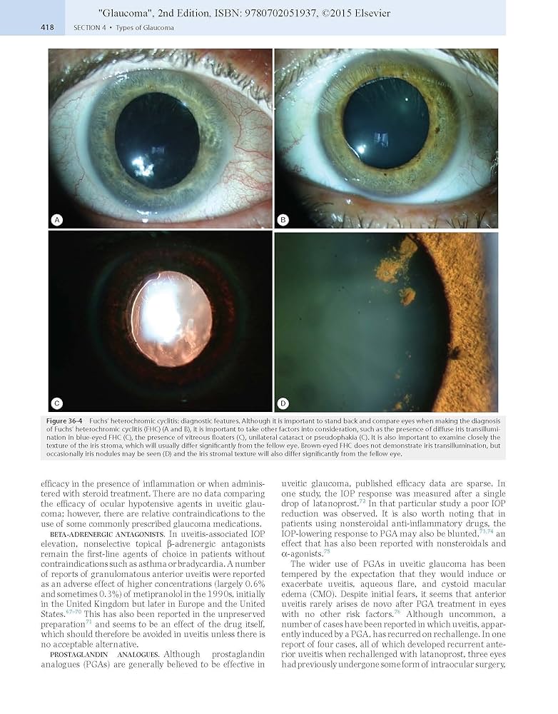 Glaucoma: 2-Volume Set: 9780702051937: Medicine & Health