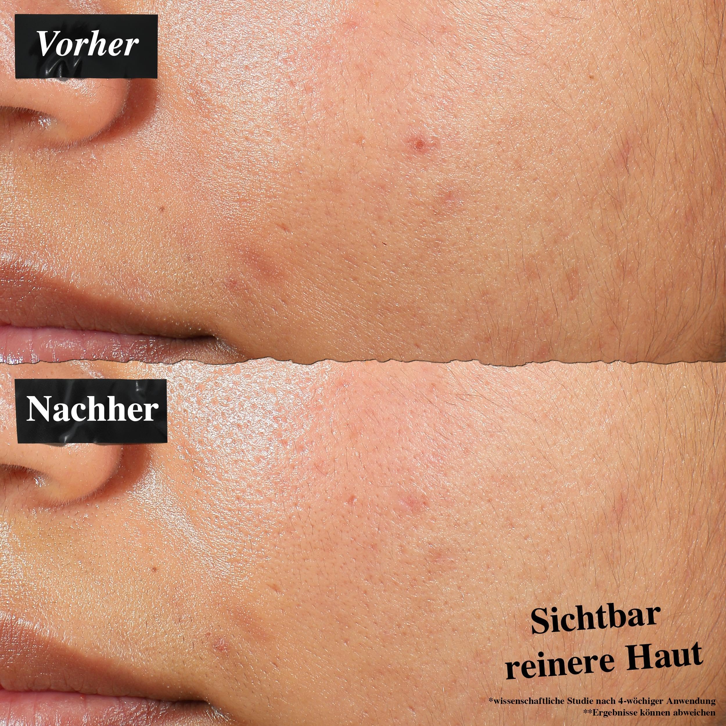 KIEHL'S Expertly Clear Blemish Treating & Preventing Lotion, 60 ml, Anti-Unreinheiten-Lotion mit Salicylsäure und Niacinamiden, zur Beseitigung und Vorbeugung von Pickeln und Unreinheiten
