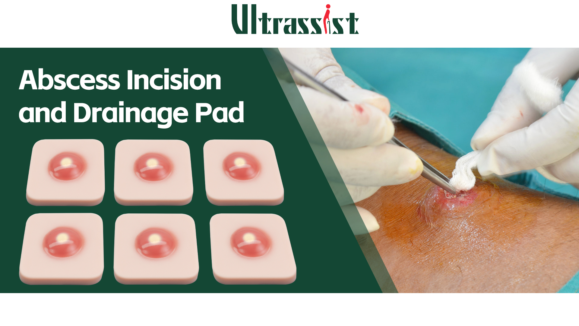 Youtube Draining Abscesses New Pimple Popping Videos 5 Stages Of An