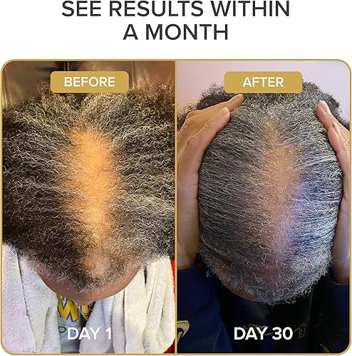 Miniatura 4 de Shedavi Vitaminas naturales icónicas para el cabello para un crecimiento rápido del cabello, suplementos puros para el cabello formulados con