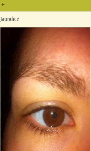 Symptoms Of Jaundice