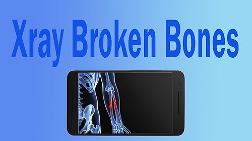 Broken Bones Xray