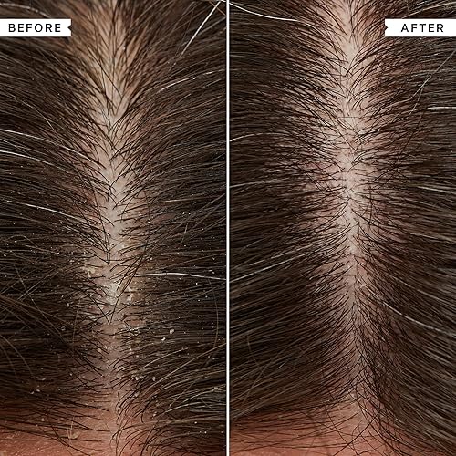 Miniatura 6 de Juego de champú y acondicionador para cuero cabelludo escamoso para limpieza del cuero cabelludo seco, productos para el cabello, calmantes, calman