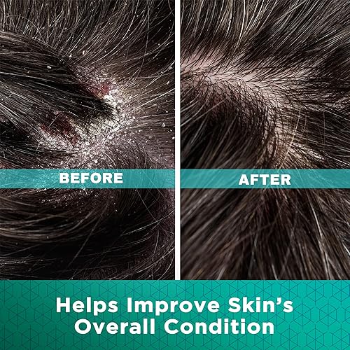 Miniatura 3 de Crema para la dermatitis seborreica Dermoscribe, 2 onzas