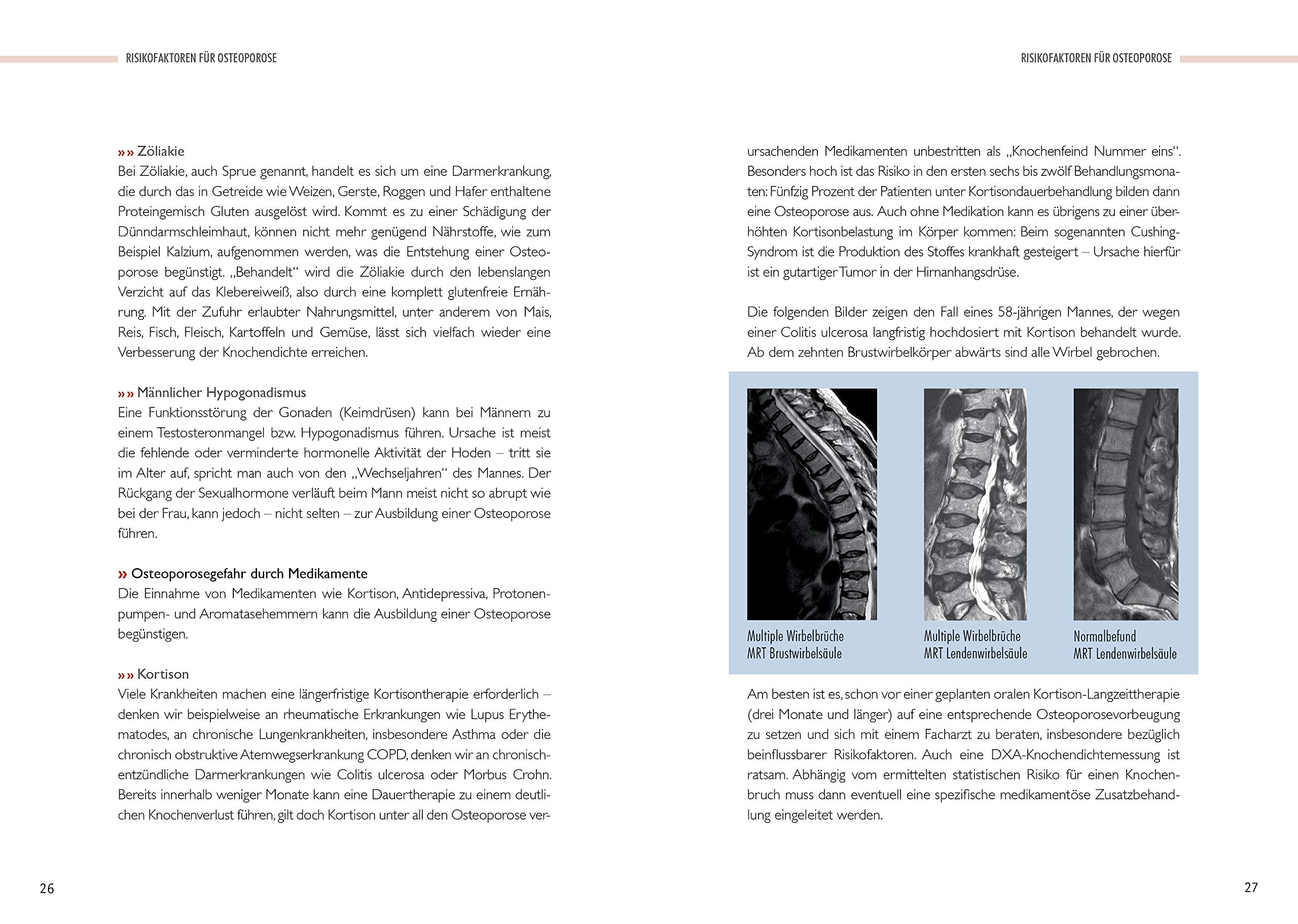 Starke Knochen: Osteoporose richtig behandeln - Diagnose, Therapie und Vorsorge