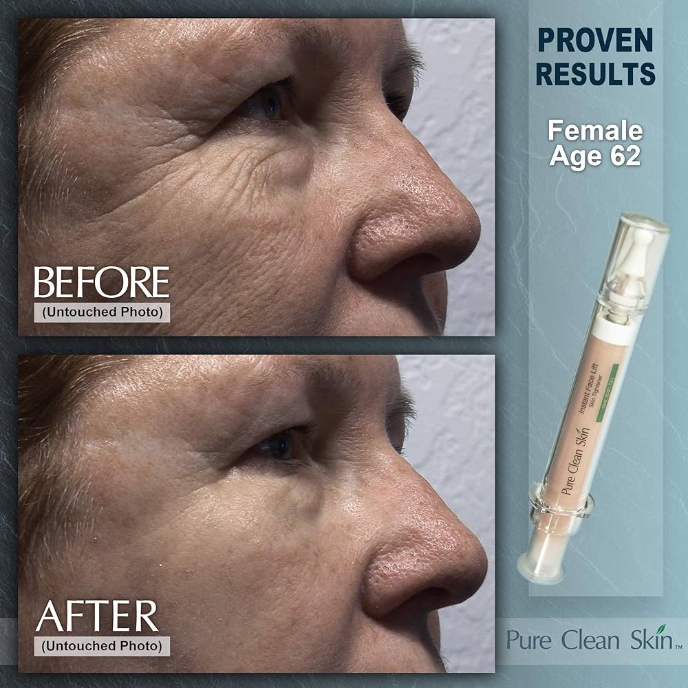 【極美品】Non-Surgical Skin Tightening and Li Exilis Ultra 360