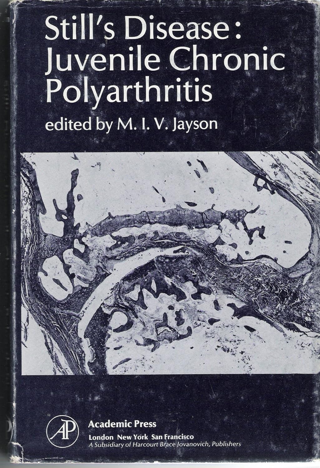 Amazon Still's Disease Juvenile Chronic Polyarthritis Jayson