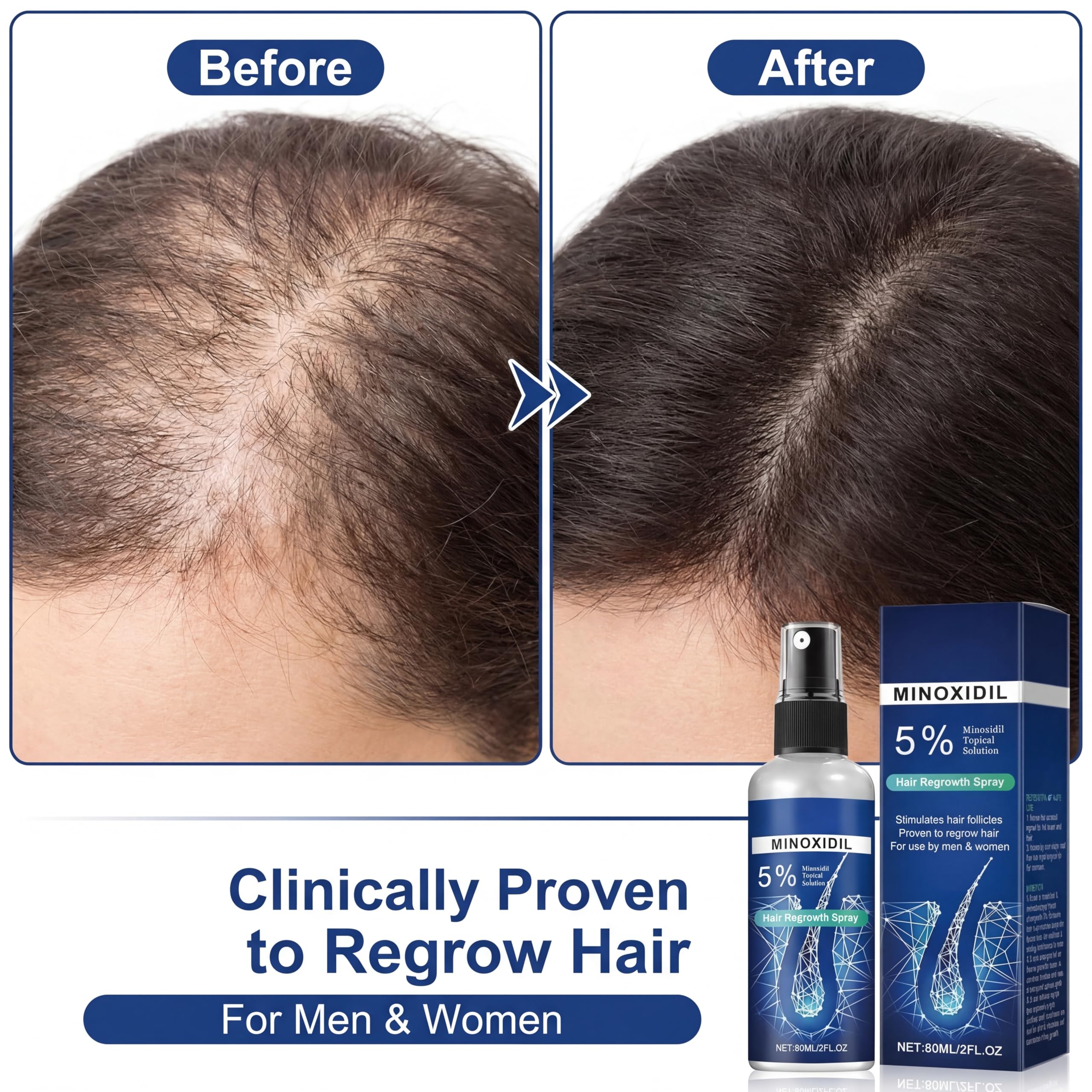Minoxidil Hair Serum spray for Men and Women, 5% Minoxidil Hair Serum，promotes hair growth, makes hair and beard thicker and fuller-60ml — view 6