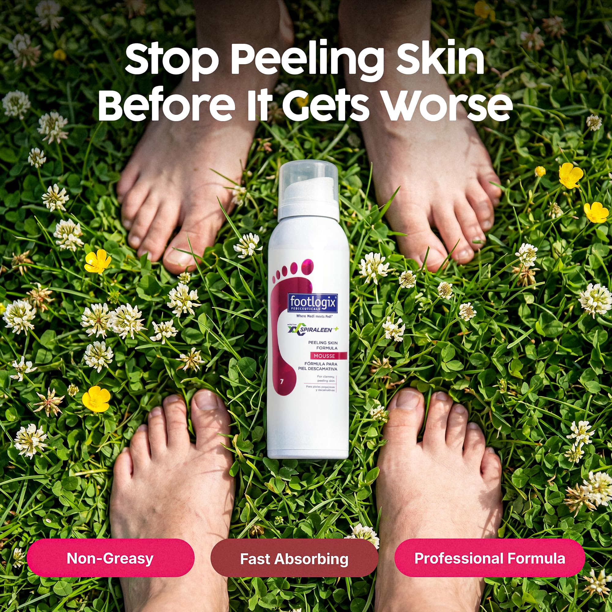 FOOTLOGIX Peeling Skin Formula Foot Care Mousse, 4.23 oz