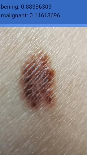 MoleScreener - Melanoma Skin Cancer Screening Tool