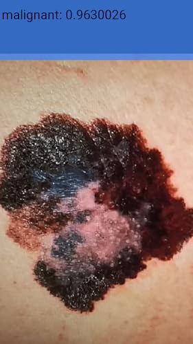 MoleScreener - Melanoma Skin Cancer Screening Tool