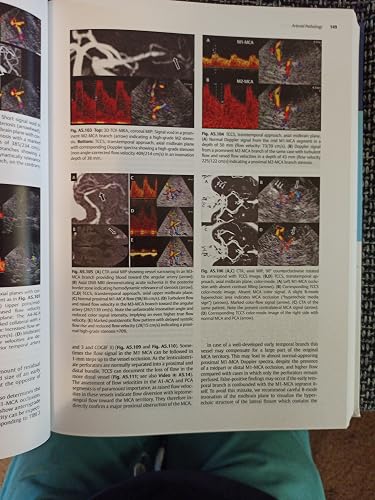 Neurosonology and Neuroimaging of Stroke: A Comprehensive Reference ...