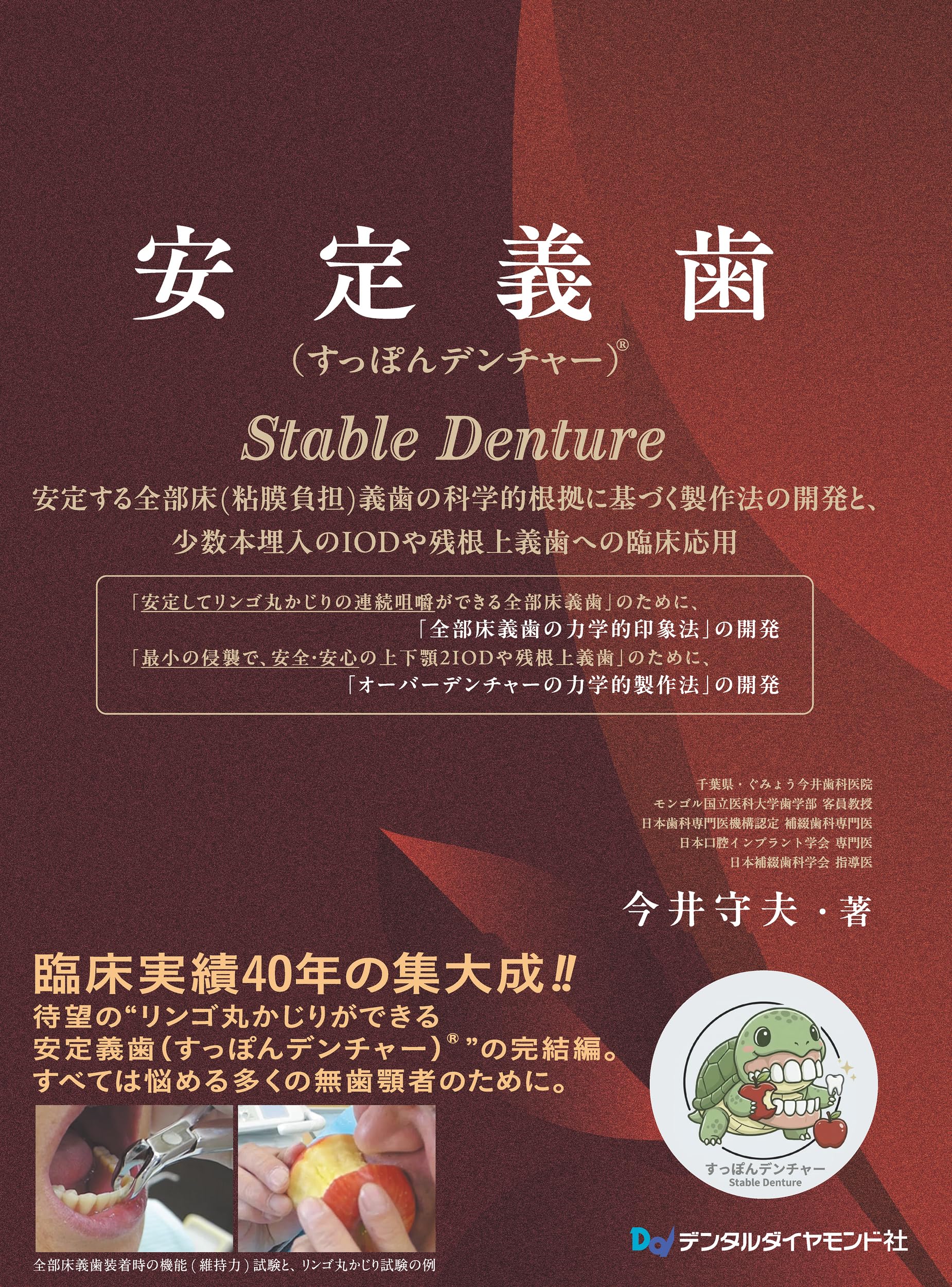 Amazon.co.jp: 安定義歯(すっぽんデンチャー)®: 安定する全部床(粘膜