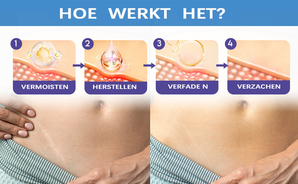 Verzorgingscrème voor littekens