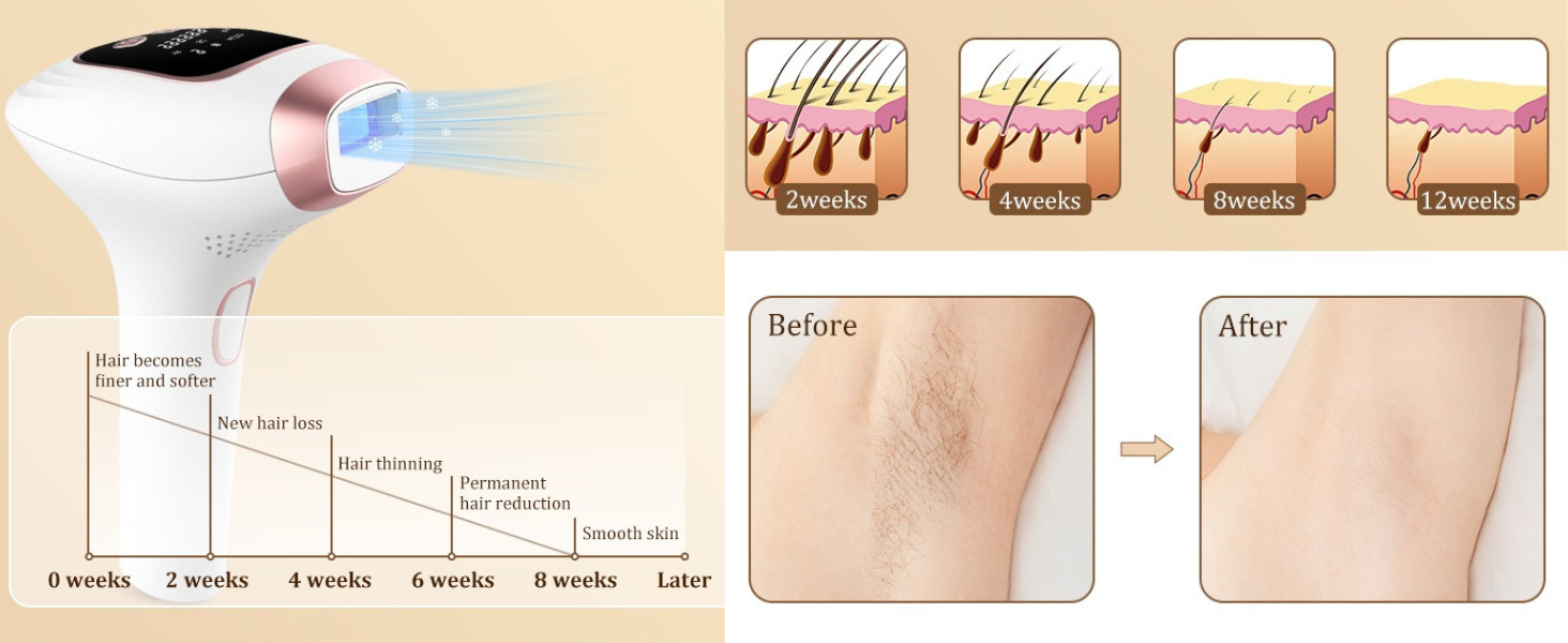 depiladora láser para mujer