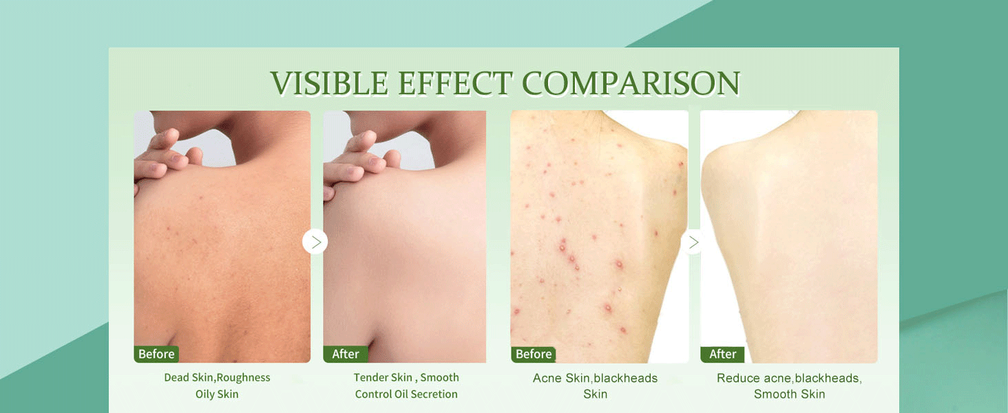 Liyalan Matcha Body Scrub Green Tea Exfoliating Body Scrubs for Acne, Dark Spots