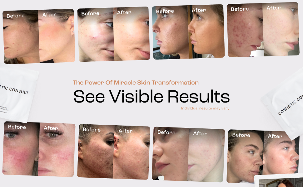 Composite of before and after facial skin treatment photos. Multiple panels show improvements in skin texture, reduction of acne, and overall complexion enhancement.