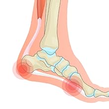 Relieve plantar fasciitis