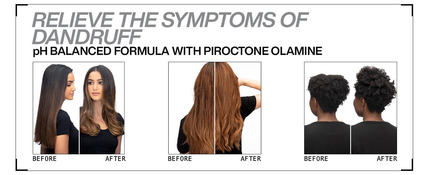 Redken Dandruff Control Shampoo, Lavender Oil, Soothes Itchy & Flaky Skin, Scalp Relief, 250