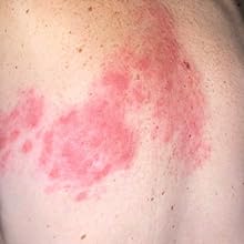 Shingles rash day 1