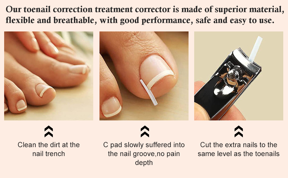 Ingrown Toenail Correction Strips Brace Kit,20 Pcs Ingrown Toenail Corrector Straightener Strips