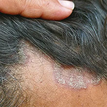 seborrheic dermatitis
