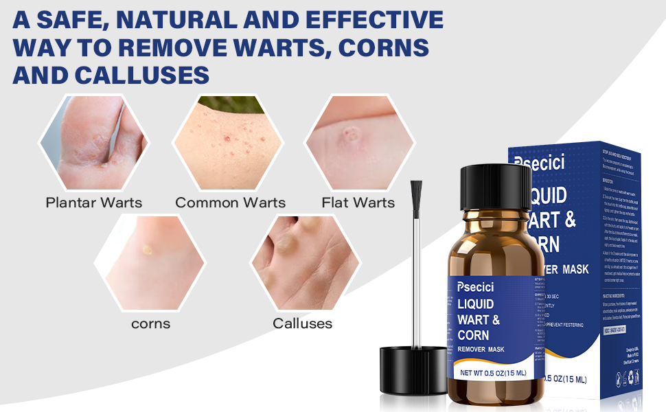wart removal