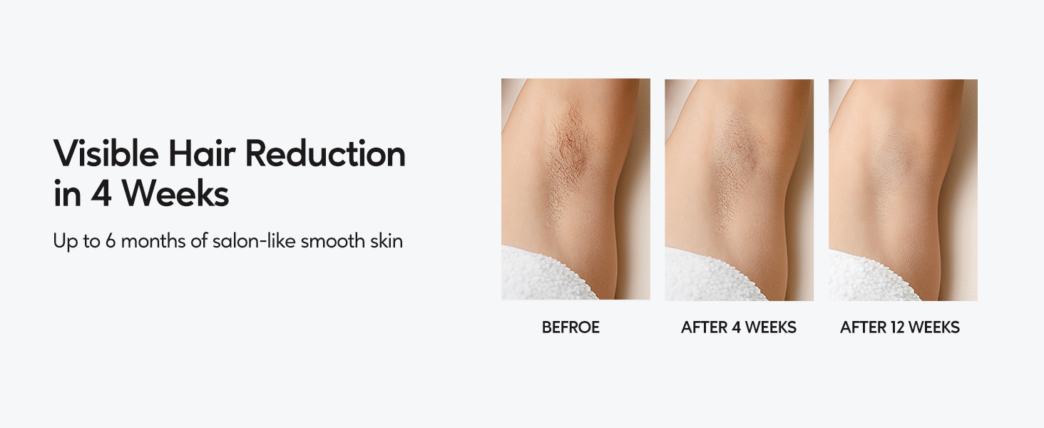 ipl hair removal