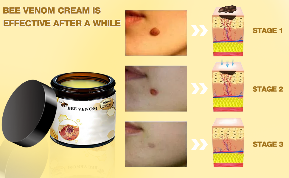 2PCS Bee Venom Cream,Bee Venom Treatment Cream,Bee Venom