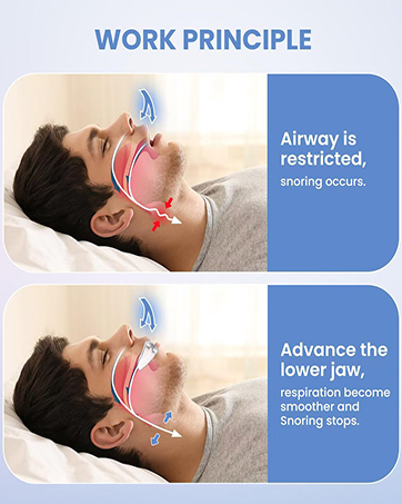 anti-snore mouthguard