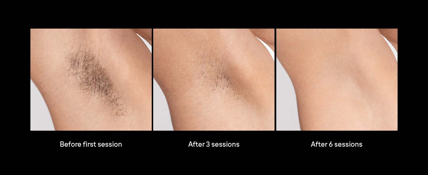 Braun Smart IPL, Skin i·Expert Pro 7