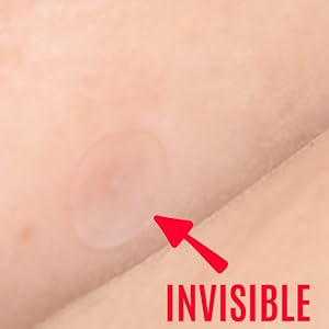 acne spot micropoints